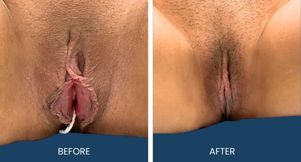Labiaplasty illustration